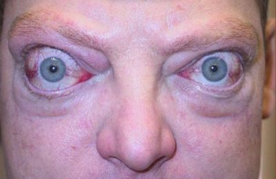 капилляры в глазах красные