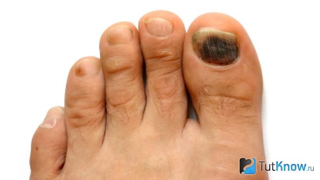 Огрубевшие ногти на ногах крупным планом